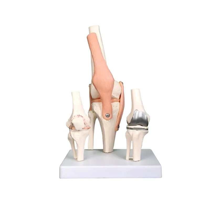LEG-3310แสดงข้อเข่าเสื่อม2ระยะ