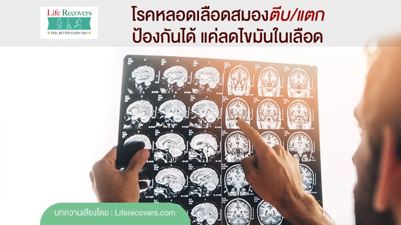 โรคหลอดเลือดตีบแตกป้องกันได้