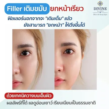 ฟิลเลอร์รีวิว2102030