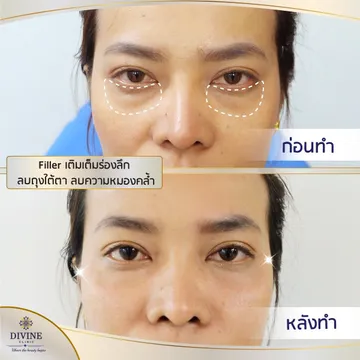 ฟิลเลอร์รีวิว21020340