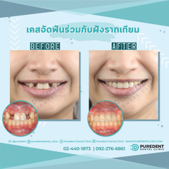 รีวิวคนไข้before-after2019จัดฟันฝังรากเทียม(0011)-01