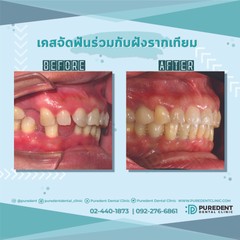 รีวิวคนไข้before-after2019จัดฟันร่วมกับฝังรากเทียม(0011)-01