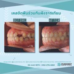 รีวิวคนไข้before-after2019จัดฟันร่วมกับฝังรากเทียม(นวลผ่อง)-01