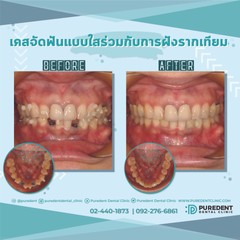 รีวิวคนไข้before-after2019จัดฟันแบบใสฝังรากเทียม(0022)-01