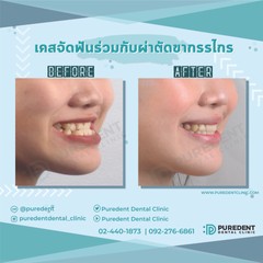 รีวิวคนไข้before-after2019ชลิตา(0011)-01