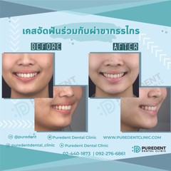 รีวิวคนไข้before-after2019ปภัสรา(0012)-01