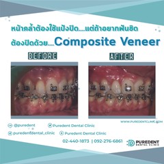 รีวิวคนไข้before-after2019วีเนียร์Composite-01