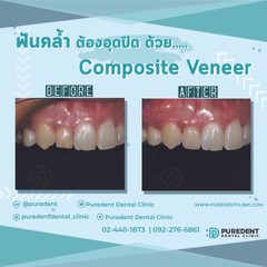 รีวิวคนไข้before-after2019วีเนียร์คอมโพสิต(006)-01