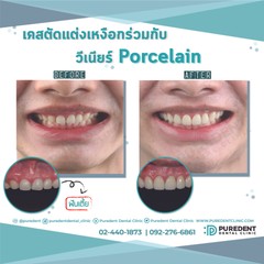 รีวิวคนไข้วีเนียร์Porcelain-01