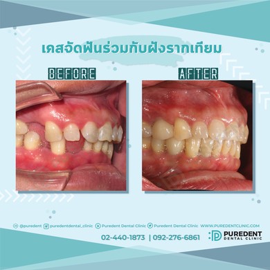 รีวิวคนไข้before-after2019จัดฟันร่วมกับฝังรากเทียม(0011)-01