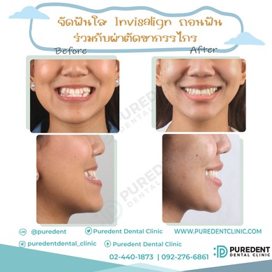รีวิวคนไข้before-after2019จัดฟันร่วมผ่าตัด(อิสรีย์1)