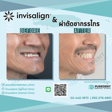 รีวิวคนไข้before-after2019จัดฟันแบบใสผ่าตัด(0011)-01