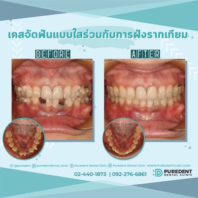 รีวิวคนไข้before-after2019จัดฟันแบบใสฝังรากเทียม(0022)-01