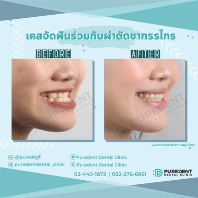 รีวิวคนไข้before-after2019ชลิตา(0011)-01