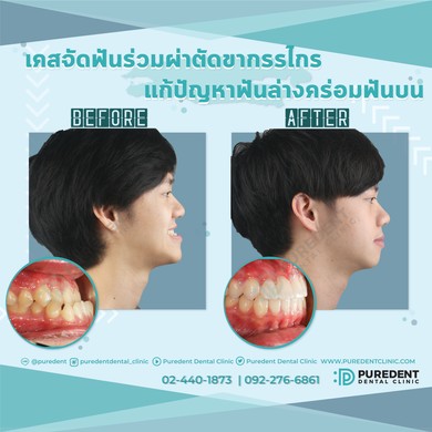 รีวิวคนไข้before-after2021จัดฟันร่วมผ่าตัดขกรรไกร(0012