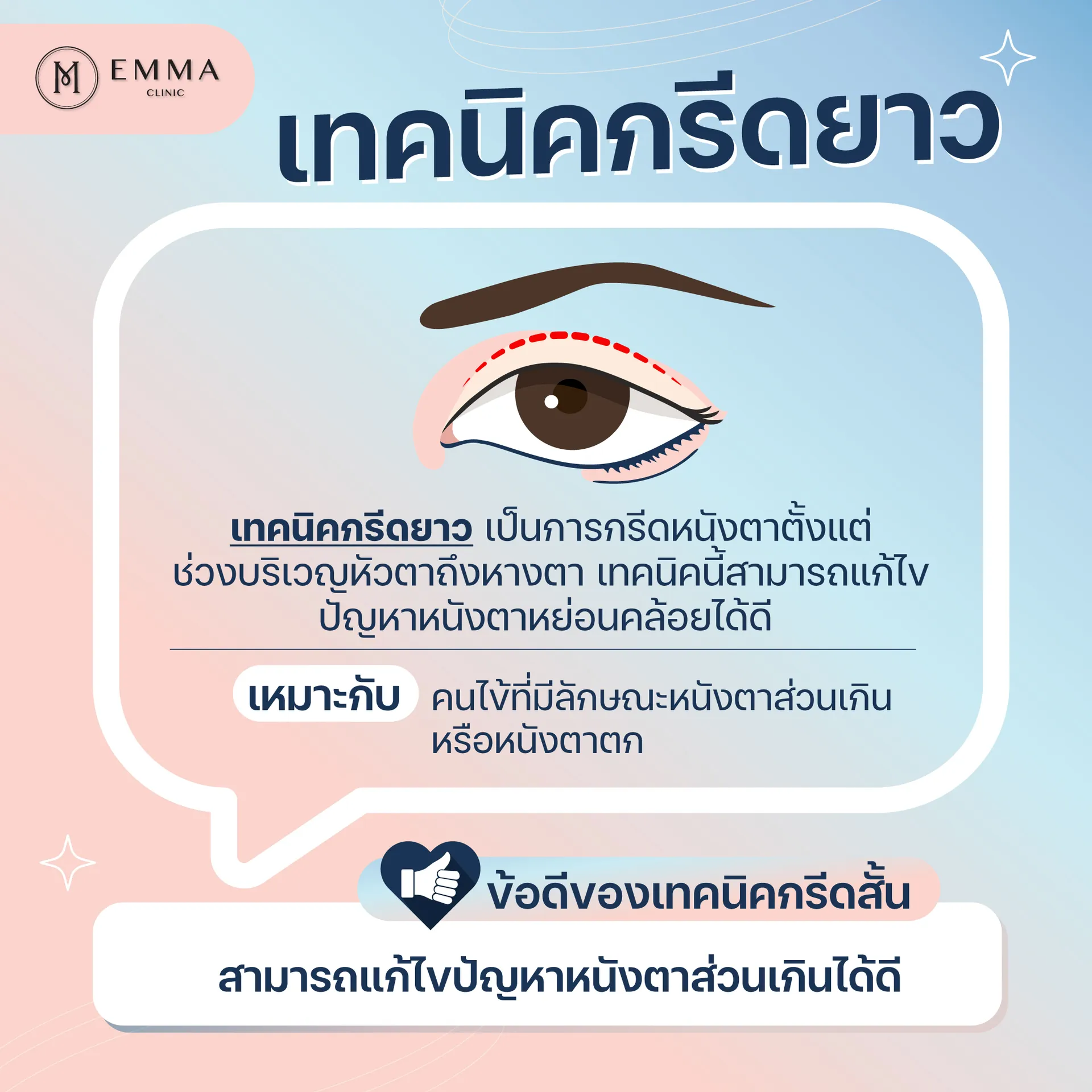 ไขข้อข้องใจตาสองชั้น เทคนิคกรีดสั้น vs เทคนิคกรีดยาว 3 กรีดตาสองชั้น-กรีดยาว