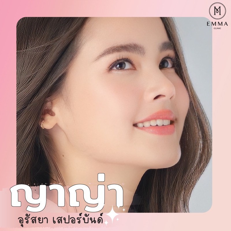 รวม 10 ดาราไอดอลไทย ที่คนไข้เอามาเป็นแบบเสริมจมูกเยอะที่สุด 4 %E0%B9%80%E0%B8%AA%E0%B8%A3%E0%B8%B4%E0%B8%A1%E0%B8%88%E0%B8%A1%E0%B8%B9%E0%B8%81%E0%B8%94%E0%B8%B2%E0%B8%A3%E0%B8%B2%E0%B9%84%E0%B8%97%E0%B8%A2%E0%B8%8D%E0%B8%B2%E0%B8%8D%E0%B9%88%E0%B8%B2z z439636085950 EMMA CLINIC