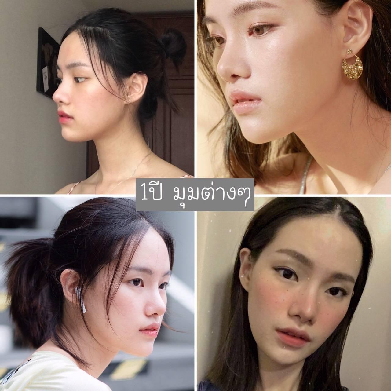 รีวิวเสริมจมูกทรงธรรมชาติ ที่ Emma Clinic 10 200618Reviews31157438204769
