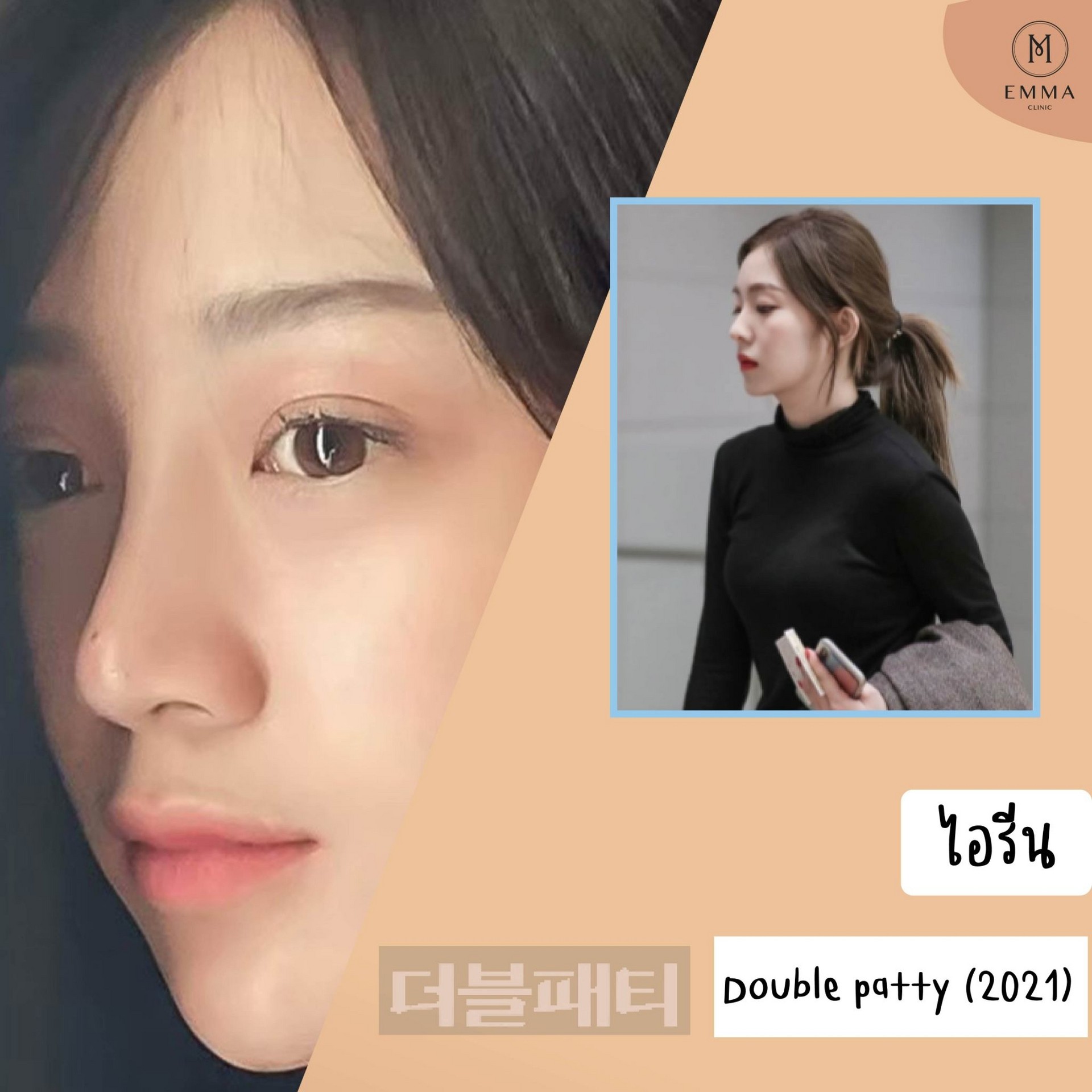 เทียบกันชัด ๆ จมูกลูกสาว Emma Clinic กับดาราไอดอลเกาหลี 10 9ไอรีนน-01