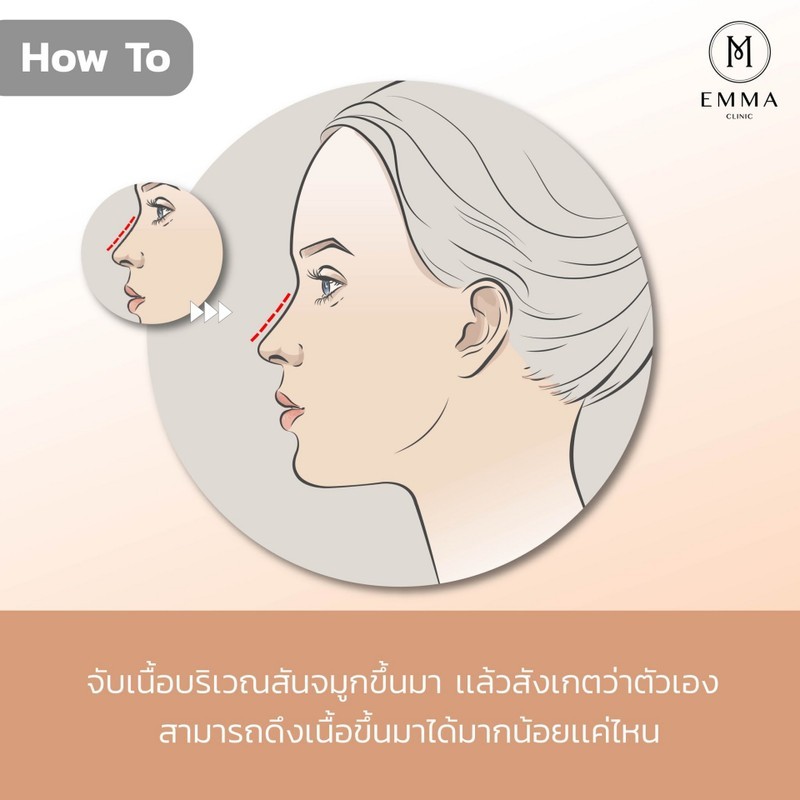 How to ดูเนื้อจมูก เสริมจมูกออกมาโด่งได้แค่ไหน? อ่านแล้วเข้าใจทำตามง่าย ๆ 2 Howto%E0%B8%88%E0%B8%B1%E0%B8%9A%E0%B9%80%E0%B8%99%E0%B8%B7%E0%B9%89%E0%B8%AD%E0%B8%AA%E0%B8%B1%E0%B8%99%E0%B8%88%E0%B8%A1%E0%B8%B9%E0%B8%81z z395567080120 EMMA CLINIC