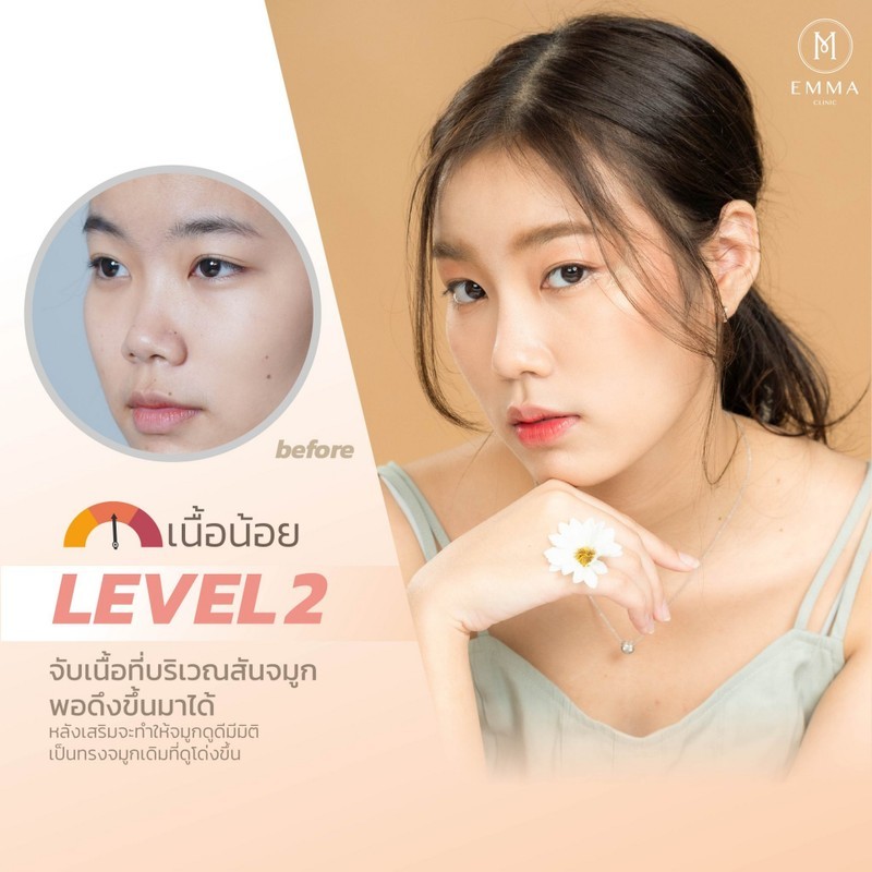 How to ดูเนื้อจมูก เสริมจมูกออกมาโด่งได้แค่ไหน? อ่านแล้วเข้าใจทำตามง่าย ๆ 6 Level2z z714726359578 EMMA CLINIC