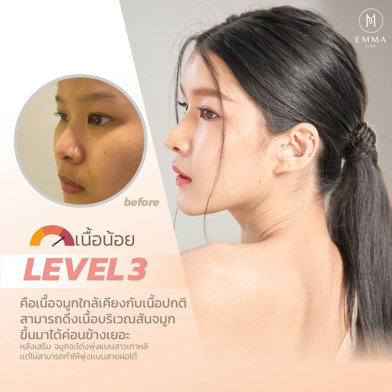 How to ดูเนื้อจมูก เสริมจมูกออกมาโด่งได้แค่ไหน? อ่านแล้วเข้าใจทำตามง่าย ๆ 3 Level3z z1509817818498 EMMA CLINIC