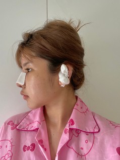 รีวิวเสริมจมูกโอเพ่น ปรับโครงสร้างจมูก เบี้ยว เอียง ด้วยเทคนิคยืดกระดูกปีกนก ให้ปลายพุ่งสุดจึ๊ง 5 หลังเสริมจมูกโอเพ่น สวยปัง 1z z339701399119 EMMA CLINIC