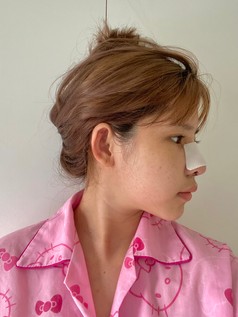 รีวิวเสริมจมูกโอเพ่น ปรับโครงสร้างจมูก เบี้ยว เอียง ด้วยเทคนิคยืดกระดูกปีกนก ให้ปลายพุ่งสุดจึ๊ง 7 หลังเสริมจมูกโอเพ่น สวยปัง 3z z1527104098073 EMMA CLINIC