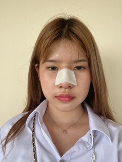 รีวิวเสริมจมูกโอเพ่น ปรับโครงสร้างจมูก เบี้ยว เอียง ด้วยเทคนิคยืดกระดูกปีกนก ให้ปลายพุ่งสุดจึ๊ง 9 เสริมจมูกโอเพ่น ดารา 2z z57184477057 EMMA CLINIC