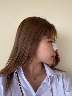 รีวิวเสริมจมูกโอเพ่น ปรับโครงสร้างจมูก เบี้ยว เอียง ด้วยเทคนิคยืดกระดูกปีกนก ให้ปลายพุ่งสุดจึ๊ง 10 เสริมจมูกโอเพ่น ดารา 3z z910399536613 EMMA CLINIC