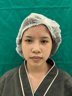 รีวิวเสริมจมูกโอเพ่น ปรับโครงสร้างจมูก เบี้ยว เอียง ด้วยเทคนิคยืดกระดูกปีกนก ให้ปลายพุ่งสุดจึ๊ง 3 แก้จมูกโอเพ่น 2z z800691595787 EMMA CLINIC
