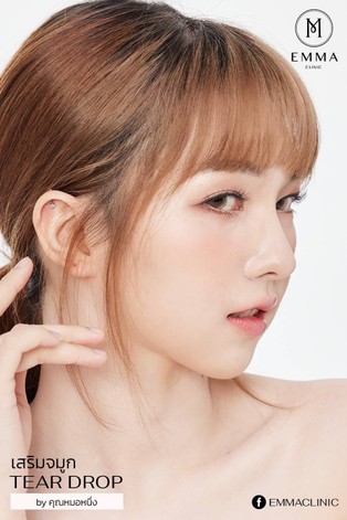 เนื้อเยื่อเทียมมีประโยชน์อย่างไร จมูกแบบไหนที่ต้องใส่เนื้อเยื่อเทียม? 5 LINEALBUM2202180z z33002087978 EMMA CLINIC