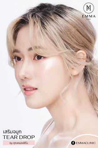 เนื้อเยื่อเทียมมีประโยชน์อย่างไร จมูกแบบไหนที่ต้องใส่เนื้อเยื่อเทียม? 4 LINEALBUM220218z z739383301780 EMMA CLINIC