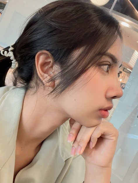 รีวิวเสริมจมูกแบบโอเพ่น ปรับโครงสร้าง ทรงสโลปสวยถูกใจ หน้าเปลี่ยนมาก 4 S97075770z z1443662568527 EMMA CLINIC