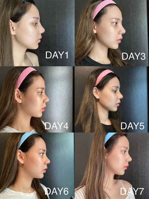 รีวิวเสริมจมูกครั้งแรก Tear Drop สันสโลป ปลายพุ่ง เพิ่มมิติ 5 %E0%B8%A3%E0%B8%B5%E0%B8%A7%E0%B8%B4%E0%B8%A7%E0%B9%80%E0%B8%AA%E0%B8%A3%E0%B8%B4%E0%B8%A1%E0%B8%88%E0%B8%A1%E0%B8%B9%E0%B8%81 %E0%B8%81%E0%B8%B2%E0%B8%A3%E0%B8%94%E0%B8%B9%E0%B9%81%E0%B8%A5%E0%B8%95%E0%B8%B1%E0%B8%A7%E0%B9%80%E0%B8%AD%E0%B8%87z z1278355501591