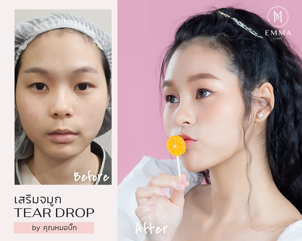 รีวิวเสริมจมูก 20 เคส คัดเน้นๆ สวยจนอยากทำตาม | EMMA Clinic 9 %E0%B8%AB%E0%B8%A1%E0%B8%AD%E0%B8%9A%E0%B8%B4%E0%B9%8A%E0%B8%814z z1196994345344
