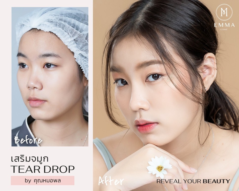 รีวิวเสริมจมูก 20 เคส คัดเน้นๆ สวยจนอยากทำตาม | EMMA Clinic 12 %E0%B8%AB%E0%B8%A1%E0%B8%AD%E0%B8%9E%E0%B8%A54z z833880627157