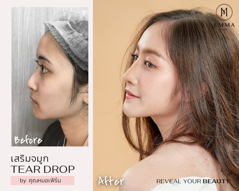 รีวิวเสริมจมูก 20 เคส คัดเน้นๆ สวยจนอยากทำตาม | EMMA Clinic 13 %E0%B8%AB%E0%B8%A1%E0%B8%AD%E0%B9%80%E0%B8%9F%E0%B8%B4%E0%B8%A3%E0%B9%8C%E0%B8%991z z906015415477
