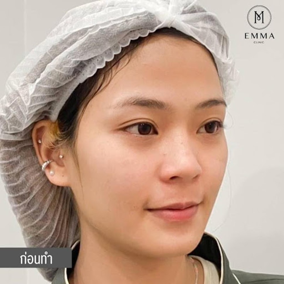 รวมรีวิวเสริมจมูกเนื้อน้อย คัดมาแบบปัง ๆ 10 เคส | EMMA Clinic 8 12z z650271193889