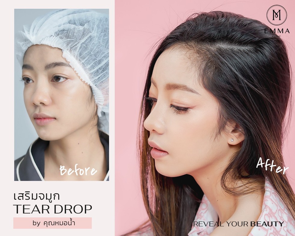 เนื้อจมูกน้อย เสริมจมูกออกมาแล้วสวยเปลี่ยนขนาดไหน? 9 n1z z193726019371