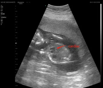 baby-cardiac