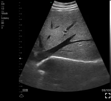 liver-B1