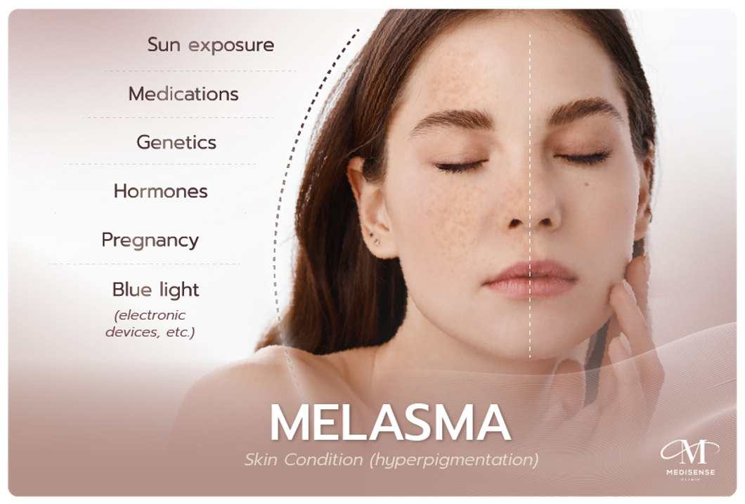 webMELASMA01-04