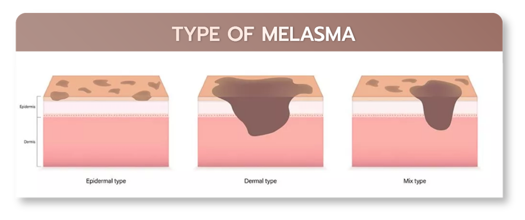 webMELASMA01-05