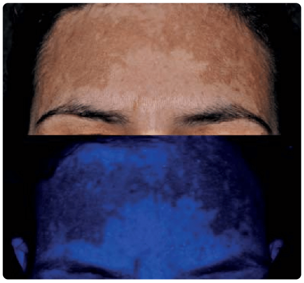 webMELASMA01-06