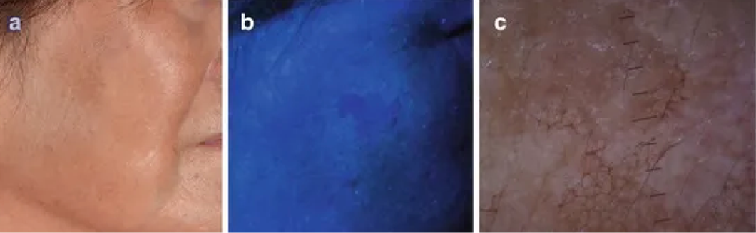 webMELASMA01-07