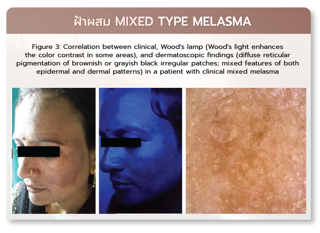 webMELASMA01-08
