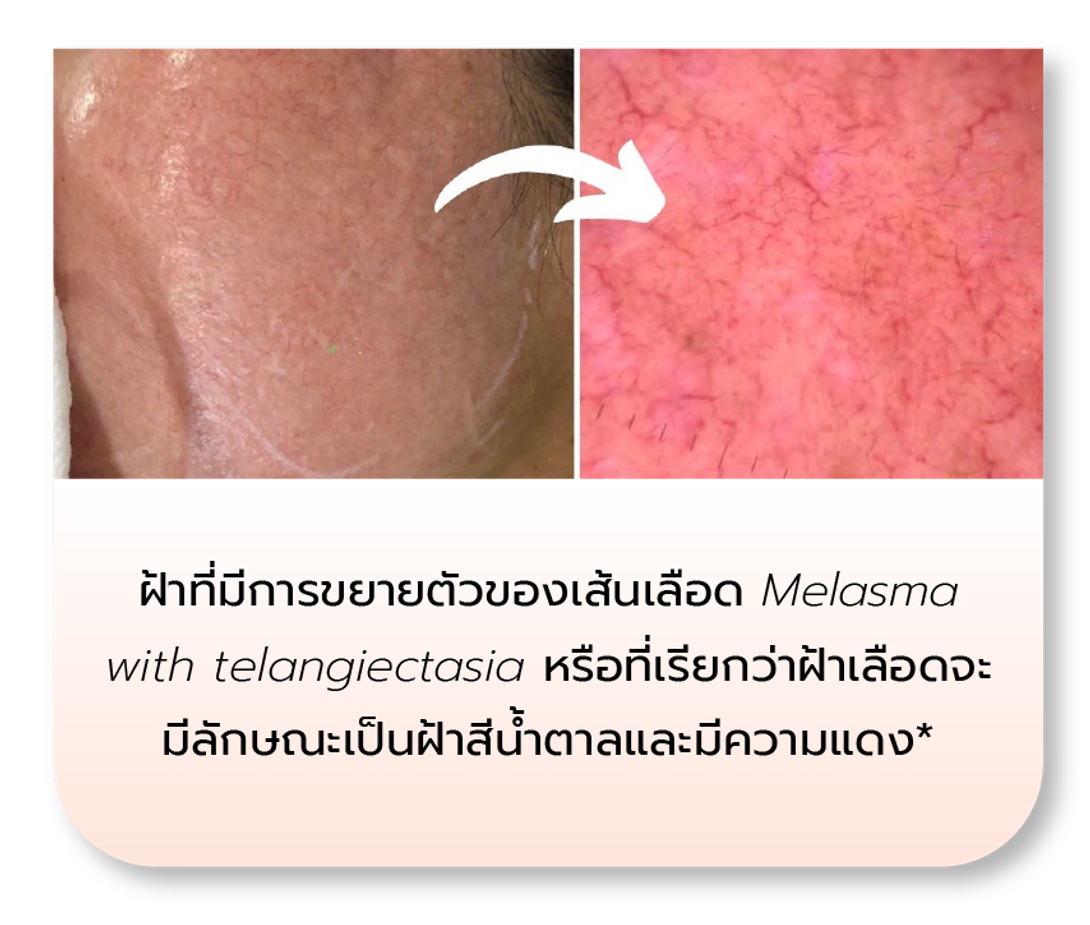 webMELASMA01-09