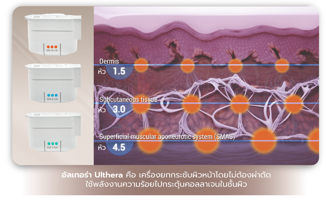 ulthera-Pic-03
