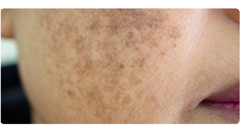 webMELASMA01-03